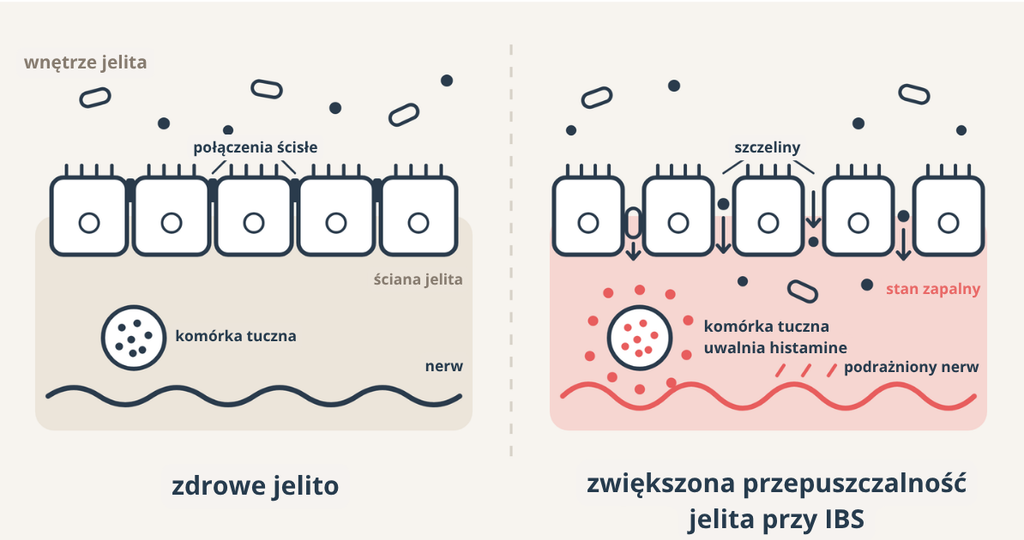 Porównanie zdrowego jelita i jelita przy IBS: rozluźnione połączenia ścisłe, komórka tuczna uwalniająca histaminę, stan zapalny i podrażniony nerw